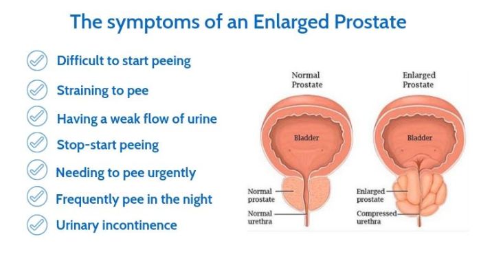 Benign prostatic hyperplasia hesi case study